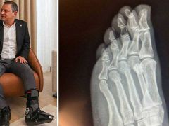 Özgür Özel’: Röntgen filmini paylaştı